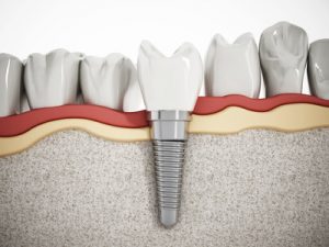 Dental implant